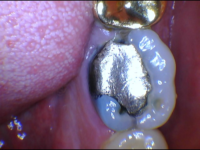 Composite white fillings in Romford and Gants Hill
